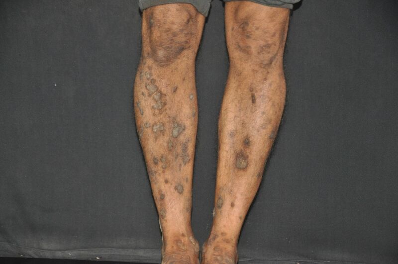 File:Fig 2- Lichen Planus.jpg