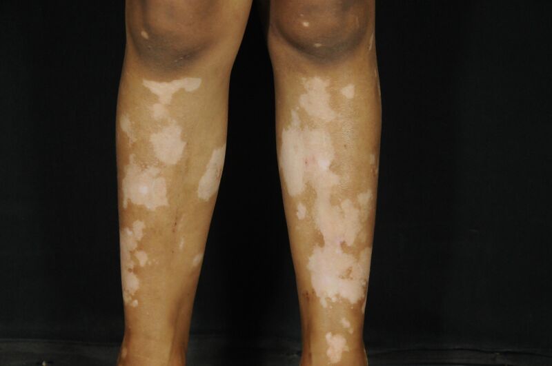 File:Fig 4- Vitiligo.jpg