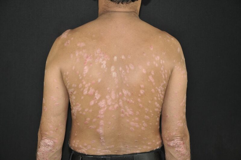 File:Fig 1- Guttate Psoriasis.jpg