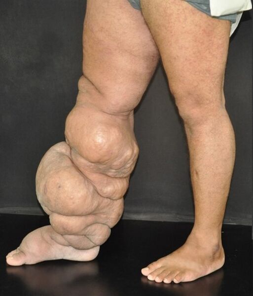 File:Fig 3-Lymphedema.jpg