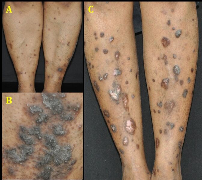 File:Fig 6- Stages of disease.jpg